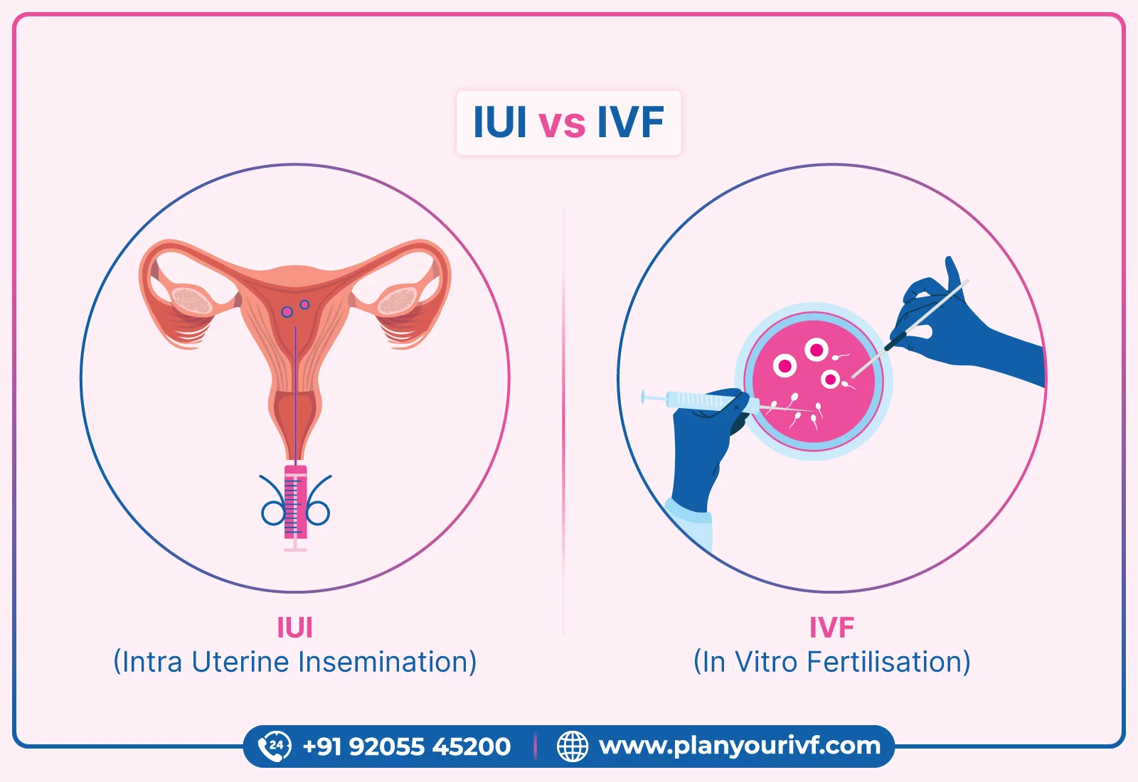 What is difference between IVF and IUI? - Planyourivf